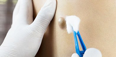 Torbiel włosowa – kiedy dolegliwości wymagają leczenia chirurgicznego?