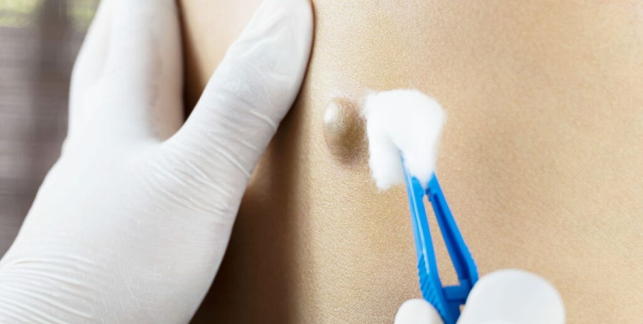 Torbiel włosowa – kiedy dolegliwości wymagają leczenia chirurgicznego?